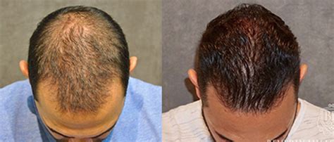 surgical hair restoration st louis mo|St. Louis, Missouri Hair Restoration .